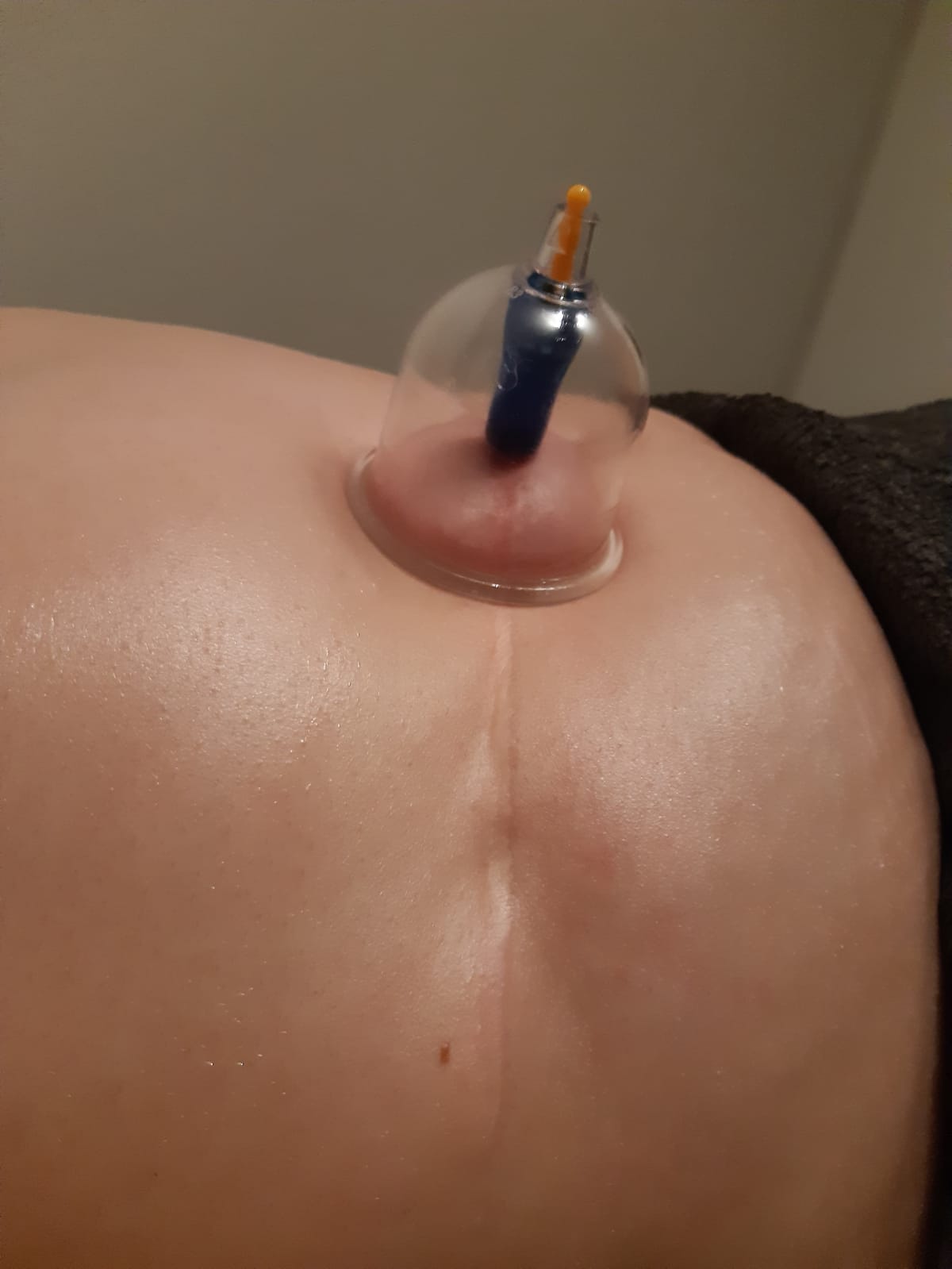 cupping yindee drunen 1 Een cupping