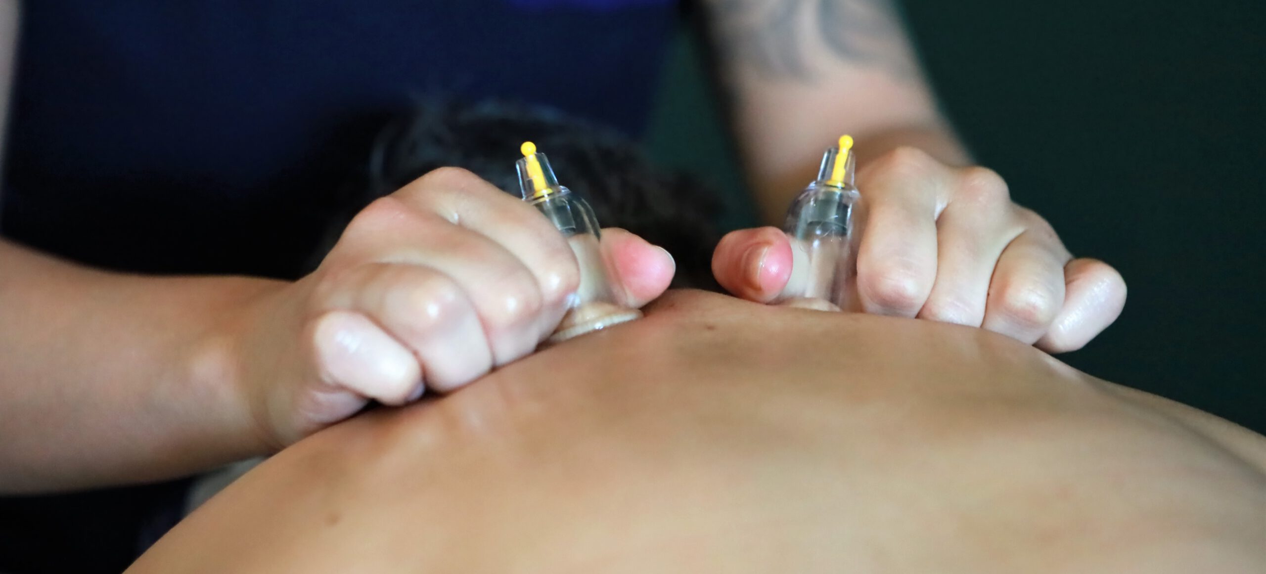 IMG_8899 (2) Cupping massage met twee cuppings